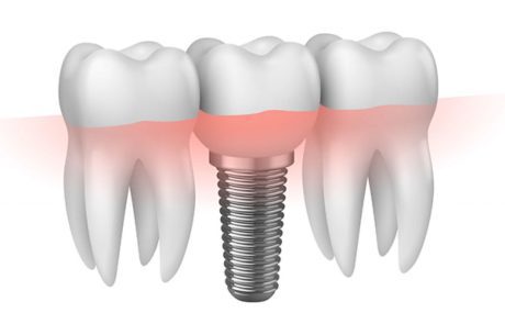tipos de implantes dentales